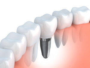 dental-implants Simi Valley